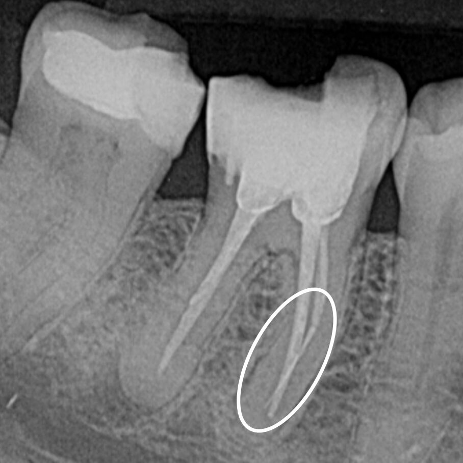 Pre-OP X-Ray with marked seperated file
