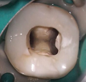 After Cleaning With EndoColibri